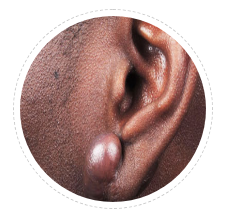 ear keloid