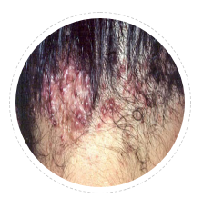 keloid