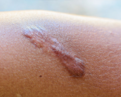 Keloid scar