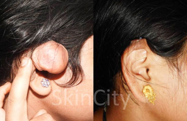 ear keloid scars