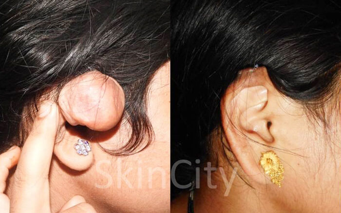 ear keloid scars